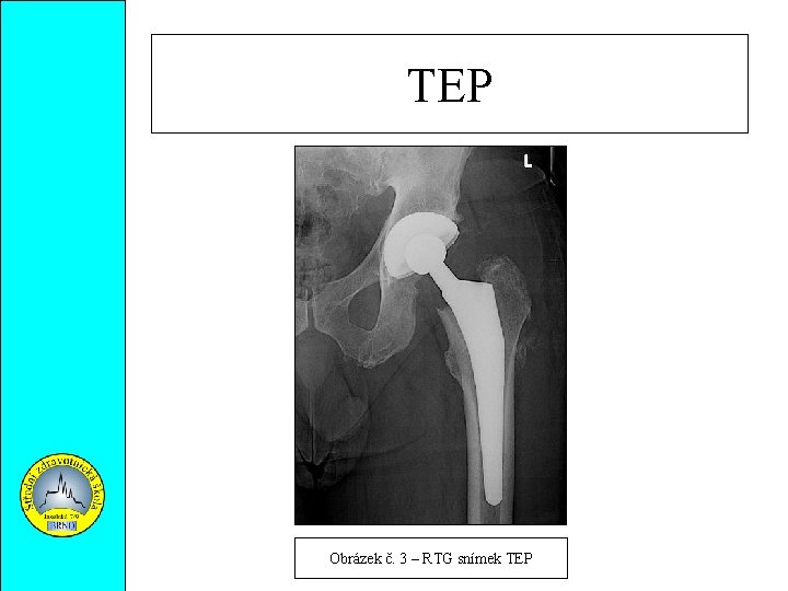 TEP Obrázek č. 3 – RTG snímek TEP 