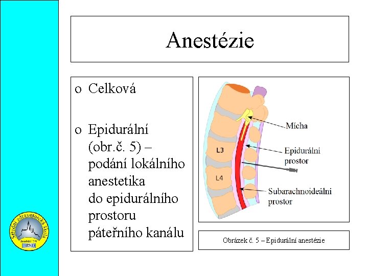 Anestézie o Celková o Epidurální (obr. č. 5) – podání lokálního anestetika do epidurálního