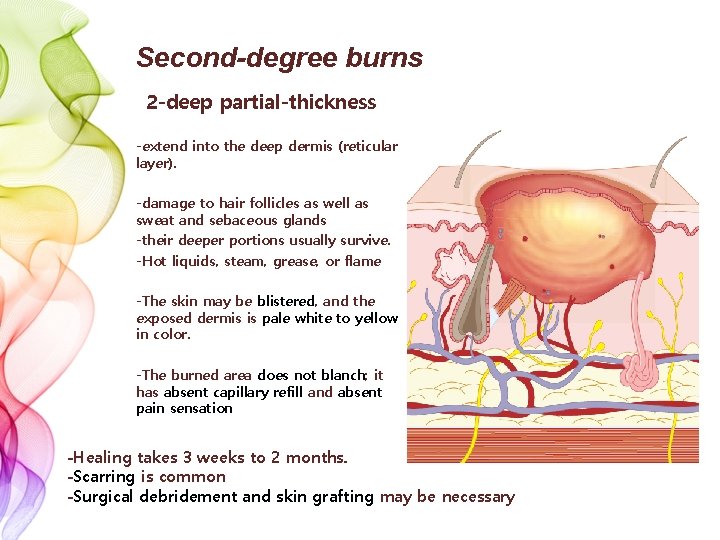 Second-degree burns 2 -deep partial-thickness -extend into the deep dermis (reticular layer). -damage to