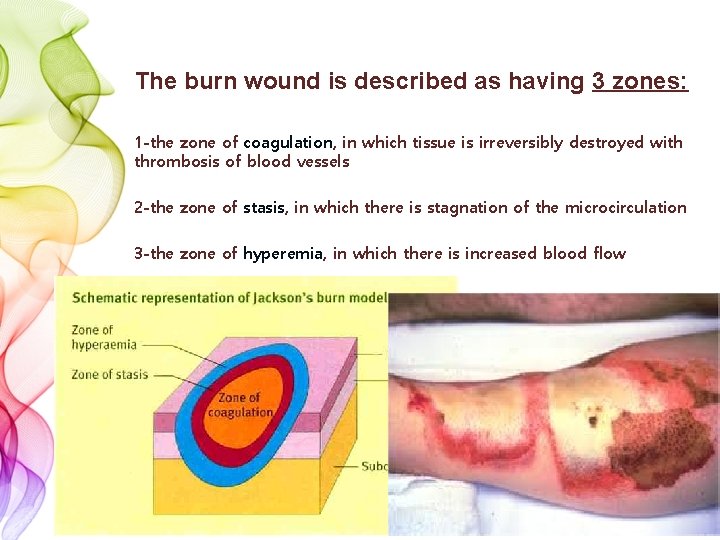 The burn wound is described as having 3 zones: 1 -the zone of coagulation,
