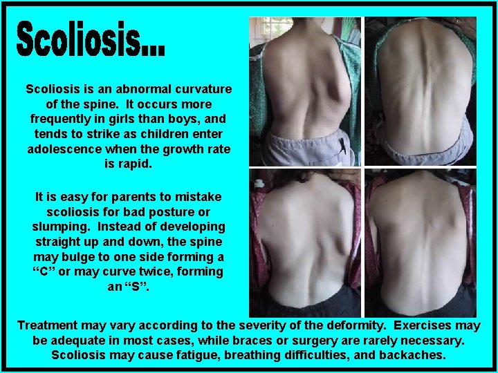 Scoliosis is an abnormal curvature of the spine. It occurs more frequently in girls