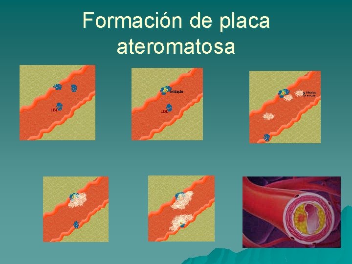 Formación de placa ateromatosa 