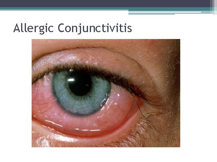 Allergic Conjunctivitis 