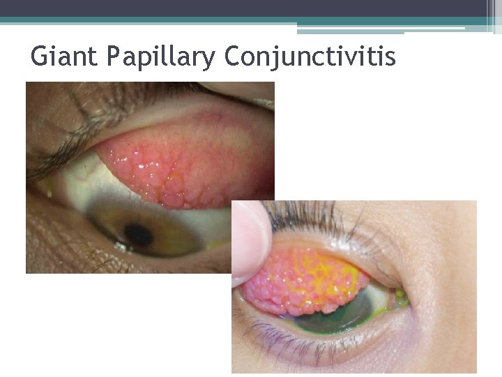 Giant Papillary Conjunctivitis 