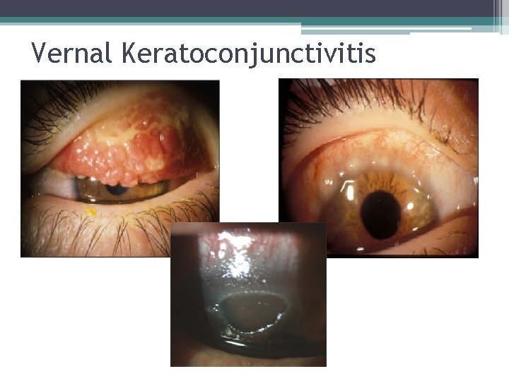 Vernal Keratoconjunctivitis 