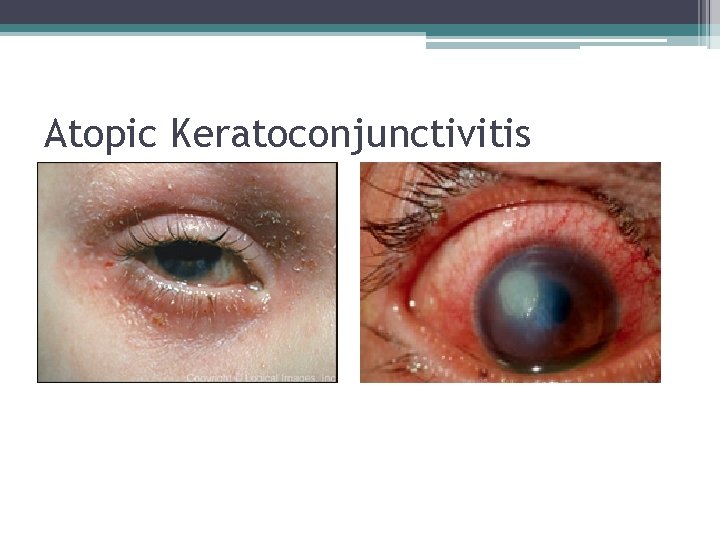 Atopic Keratoconjunctivitis 