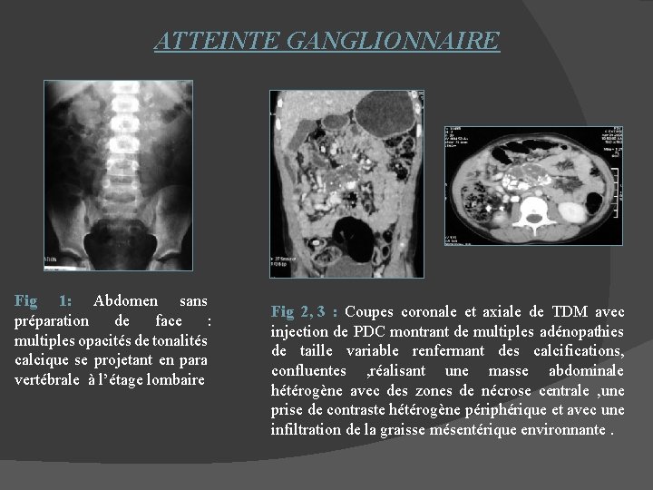 ATTEINTE GANGLIONNAIRE Fig 1: Abdomen sans préparation de face : multiples opacités de tonalités