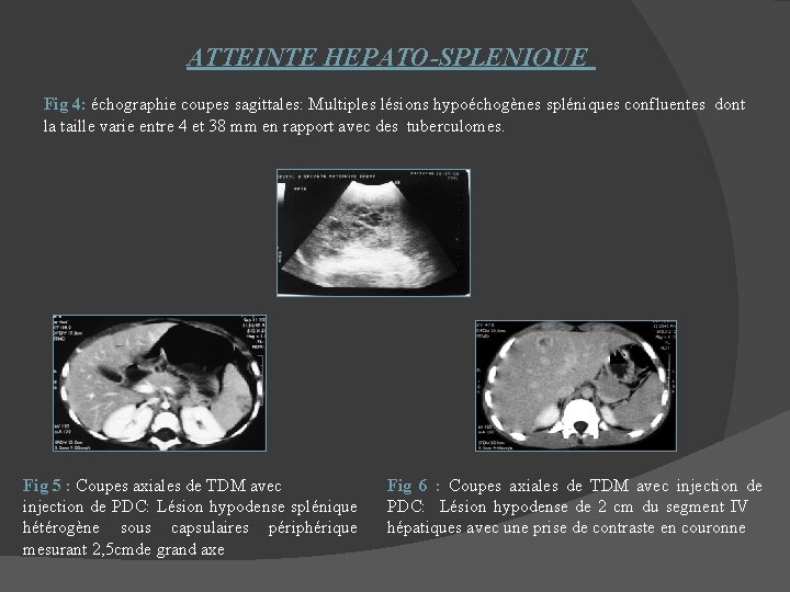  ATTEINTE HEPATO-SPLENIQUE Fig 4: échographie coupes sagittales: Multiples lésions hypoéchogènes spléniques confluentes dont