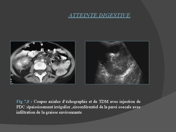 ATTEINTE DIGESTIVE Fig 7, 8 : Coupes axiales d’échographie et de TDM avec injection