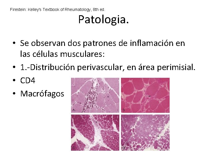 Firestein: Kelley's Textbook of Rheumatology, 8 th ed. Patologia. • Se observan dos patrones Firestein: Kelley's Textbook of Rheumatology, 8 th ed. Patologia. • Se observan dos patrones