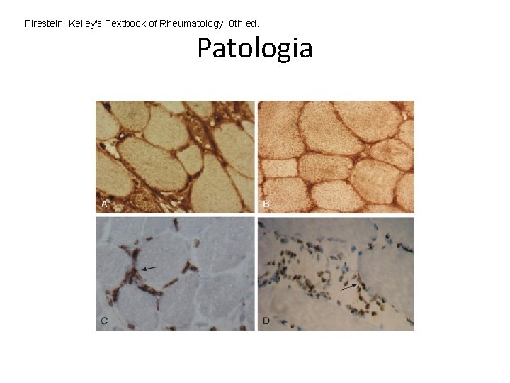 Firestein: Kelley's Textbook of Rheumatology, 8 th ed. Patologia Firestein: Kelley's Textbook of Rheumatology, 8 th ed. Patologia