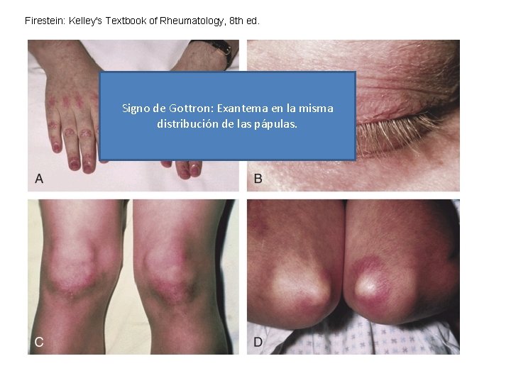 Firestein: Kelley's Textbook of Rheumatology, 8 th ed. Signo de Gottron: Exantema en la Firestein: Kelley's Textbook of Rheumatology, 8 th ed. Signo de Gottron: Exantema en la