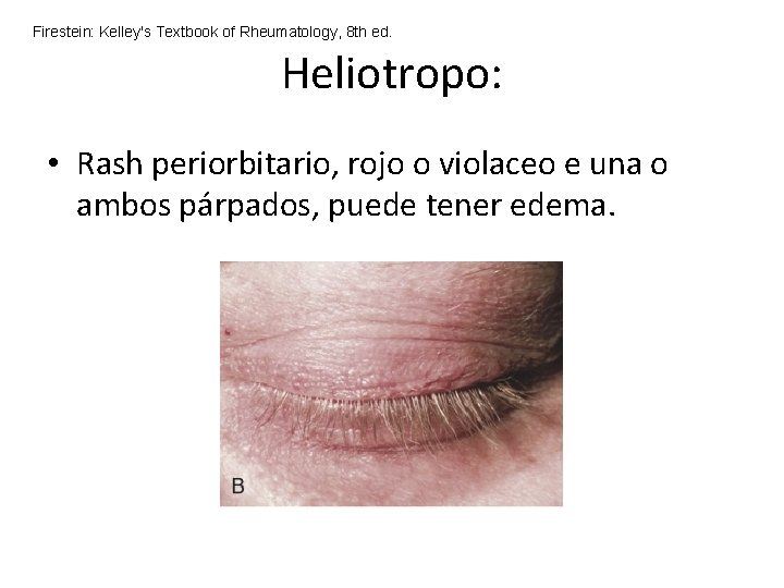 Firestein: Kelley's Textbook of Rheumatology, 8 th ed. Heliotropo: • Rash periorbitario, rojo o Firestein: Kelley's Textbook of Rheumatology, 8 th ed. Heliotropo: • Rash periorbitario, rojo o
