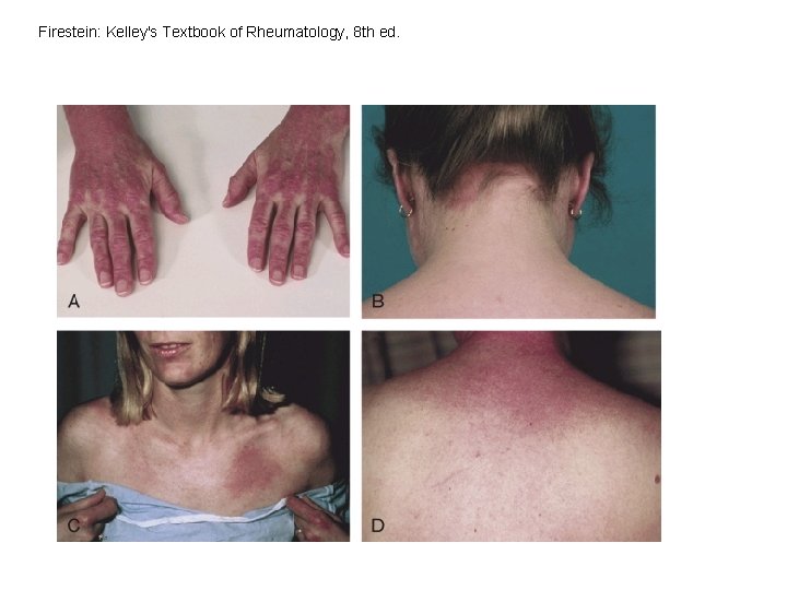Firestein: Kelley's Textbook of Rheumatology, 8 th ed. Firestein: Kelley's Textbook of Rheumatology, 8 th ed.