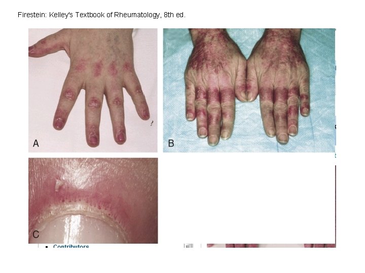 Firestein: Kelley's Textbook of Rheumatology, 8 th ed. Firestein: Kelley's Textbook of Rheumatology, 8 th ed.