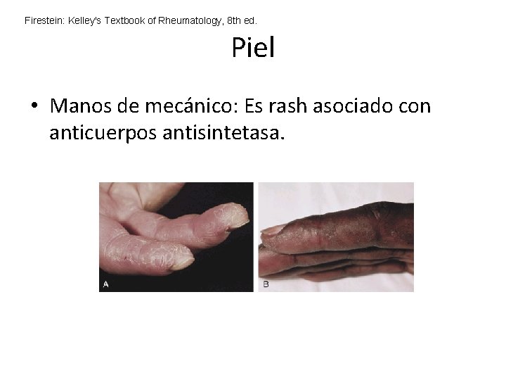 Firestein: Kelley's Textbook of Rheumatology, 8 th ed. Piel • Manos de mecánico: Es Firestein: Kelley's Textbook of Rheumatology, 8 th ed. Piel • Manos de mecánico: Es