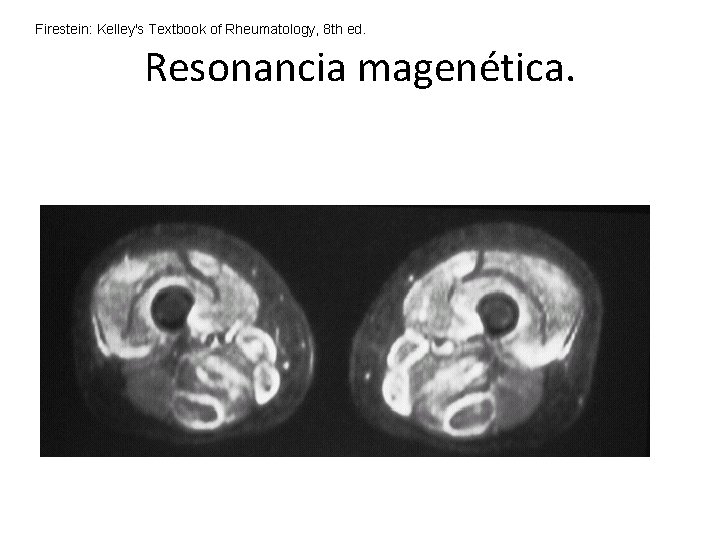 Firestein: Kelley's Textbook of Rheumatology, 8 th ed. Resonancia magenética. Firestein: Kelley's Textbook of Rheumatology, 8 th ed. Resonancia magenética.