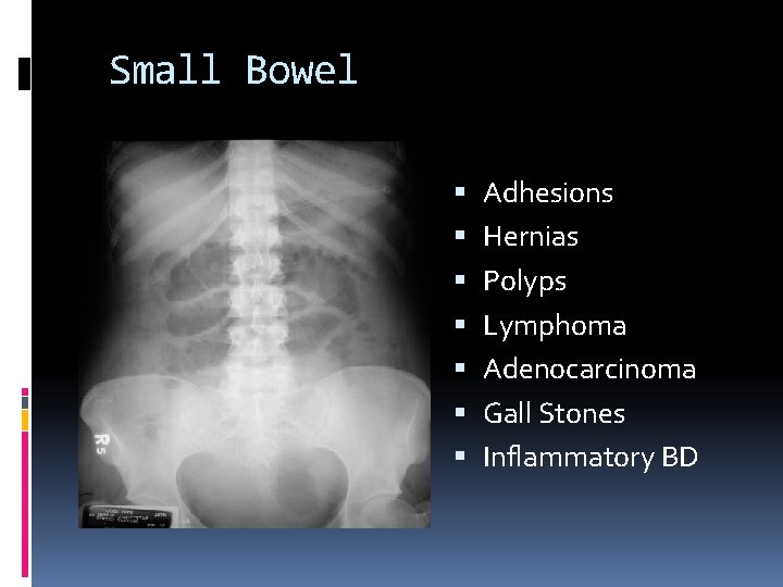 Small Bowel Adhesions Hernias Polyps Lymphoma Adenocarcinoma Gall Stones Inflammatory BD 