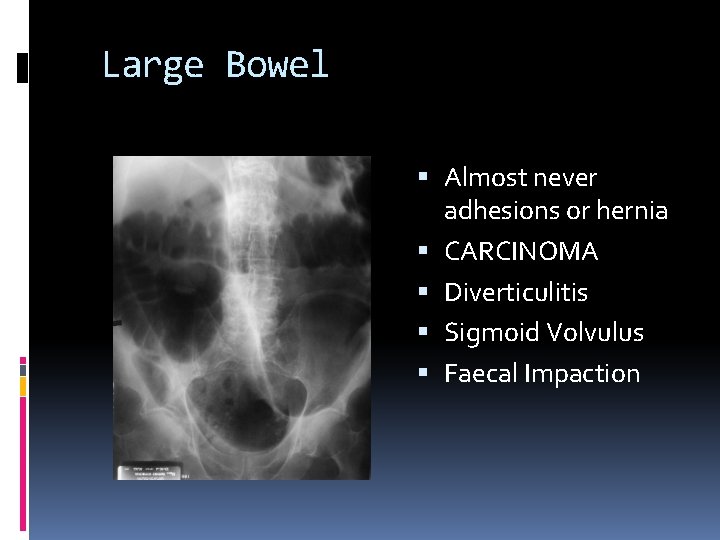 Large Bowel Almost never adhesions or hernia CARCINOMA Diverticulitis Sigmoid Volvulus Faecal Impaction 