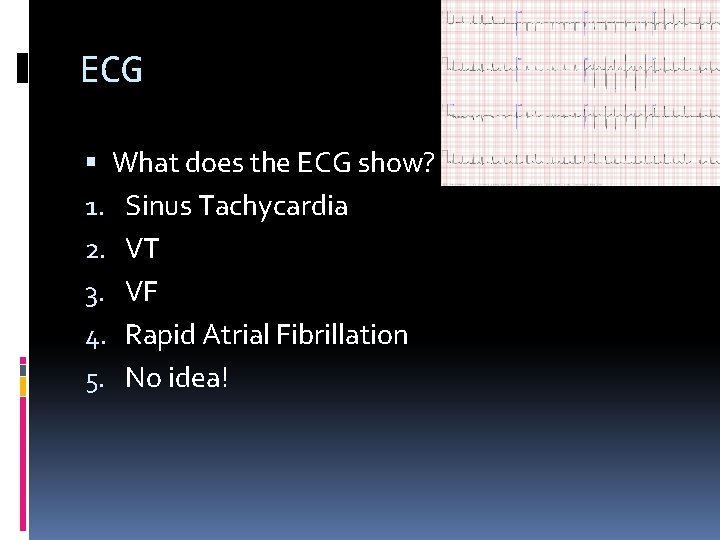 ECG What does the ECG show? 1. Sinus Tachycardia 2. VT 3. VF 4.