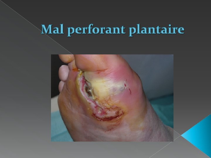 Mal perforant plantaire 