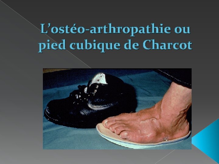 L’ostéo-arthropathie ou pied cubique de Charcot 