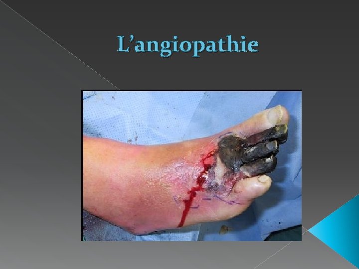 L’angiopathie 
