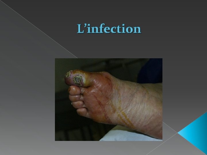 L’infection 