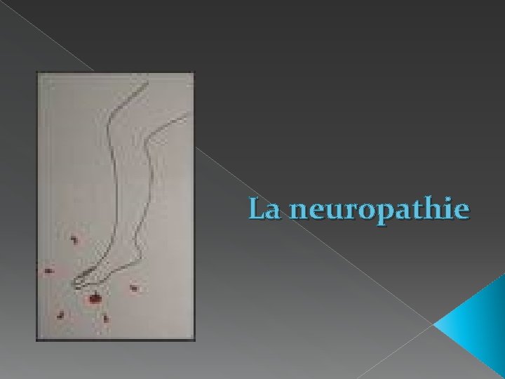 La neuropathie 
