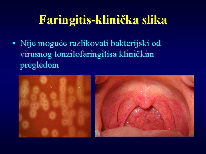 Faringitis-klinička slika • Nije moguće razlikovati bakterijski od virusnog tonzilofaringitisa kliničkim pregledom 