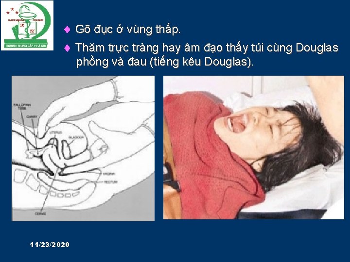  Gõ đục ở vùng thấp. Thăm trực tràng hay âm đạo thấy túi