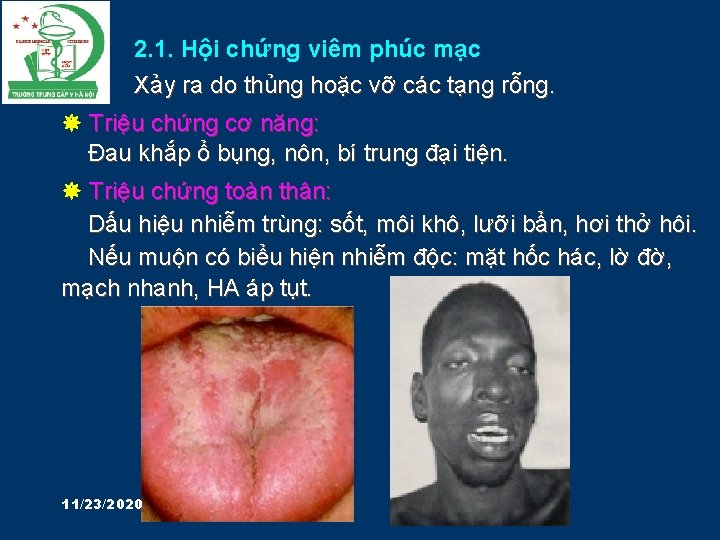 2. 1. Hội chứng viêm phúc mạc Xảy ra do thủng hoặc vỡ các