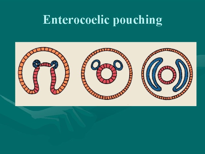 Enterocoelic pouching 