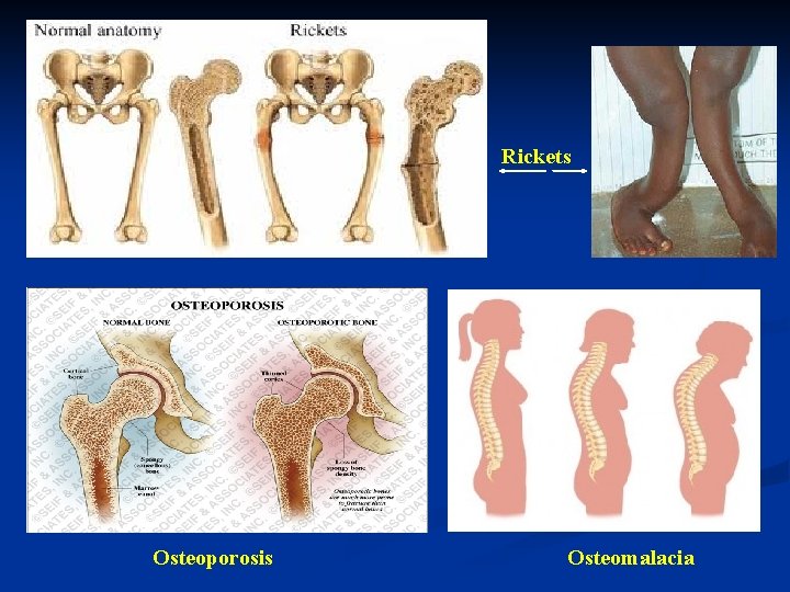 Rickets Osteoporosis Osteomalacia 