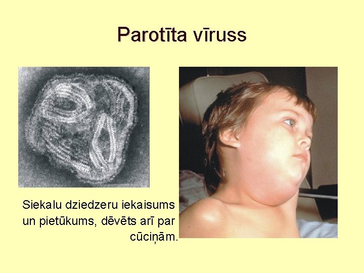 Parotīta vīruss Siekalu dziedzeru iekaisums un pietūkums, dēvēts arī par cūciņām. 
