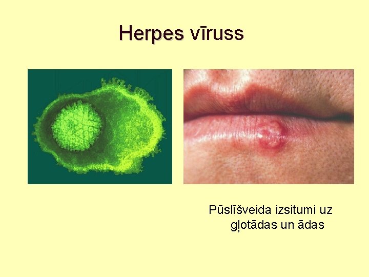 Herpes vīruss Pūslīšveida izsitumi uz gļotādas un ādas 