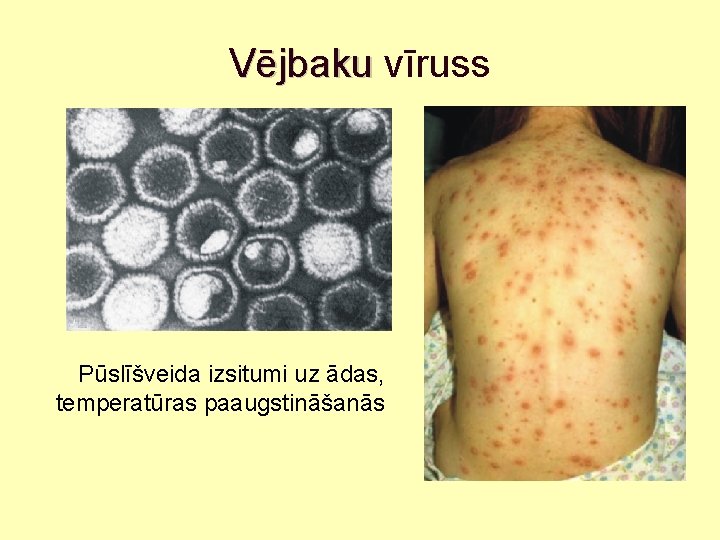Vējbaku vīruss Pūslīšveida izsitumi uz ādas, temperatūras paaugstināšanās 