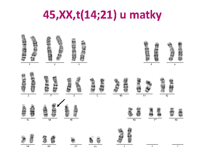 45, XX, t(14; 21) u matky 