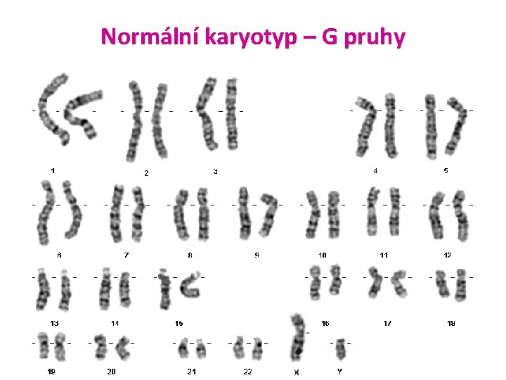 Normální karyotyp – G pruhy 