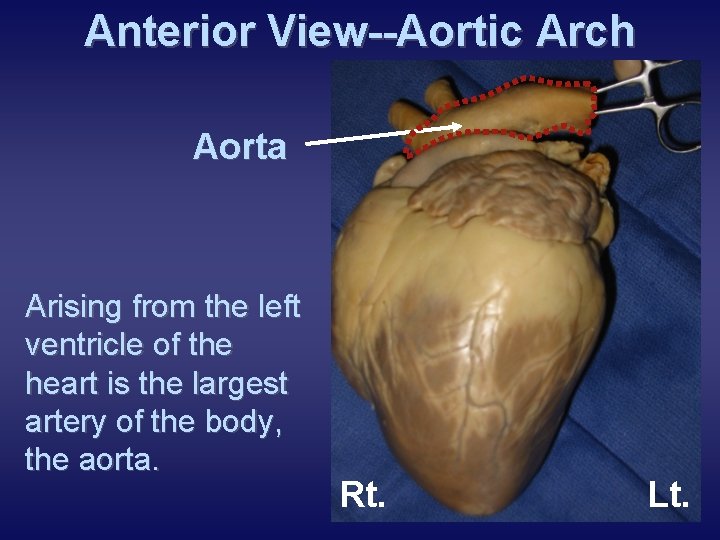 Anterior View--Aortic Arch Aorta Arising from the left ventricle of the heart is the