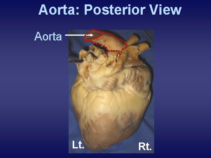 Aorta: Posterior View Aorta Lt. Rt. 