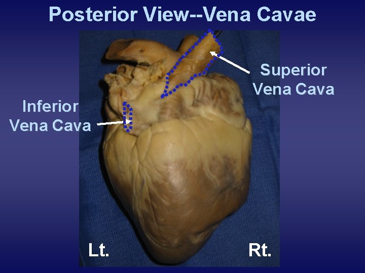 Posterior View--Vena Cavae Inferior Vena Cava Lt. Superior Vena Cava Rt. 