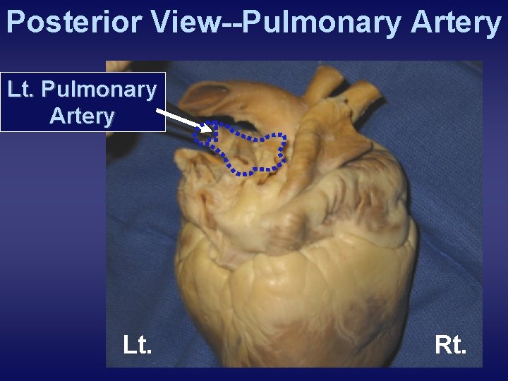 Posterior View--Pulmonary Artery Lt. Rt. 