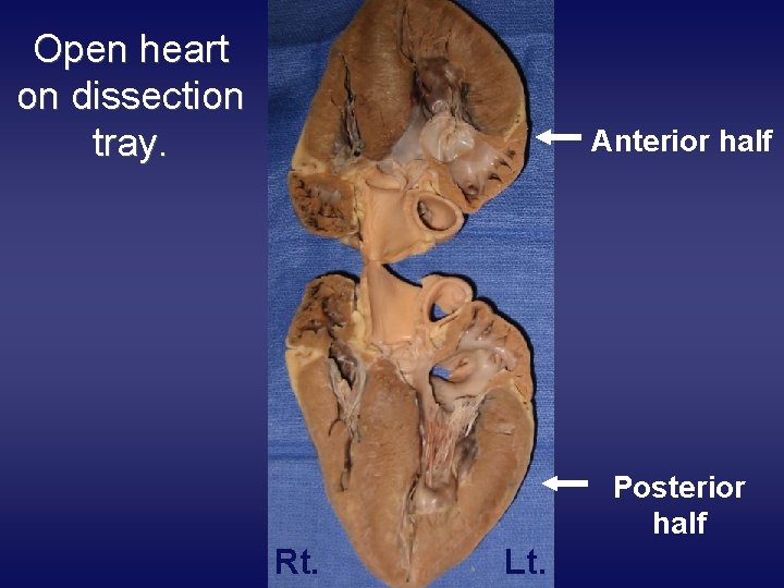 Open heart on dissection tray. Anterior half Posterior half Rt. Lt. 