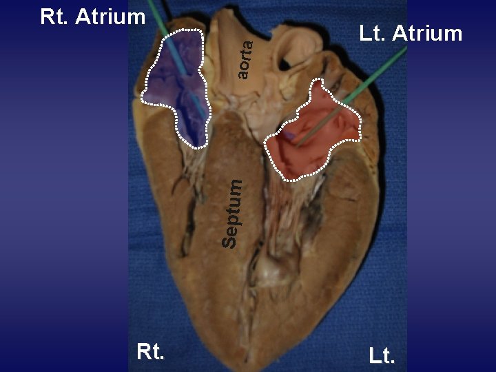 Lt. Atrium Septum aorta Rt. Atrium Rt. Lt. 