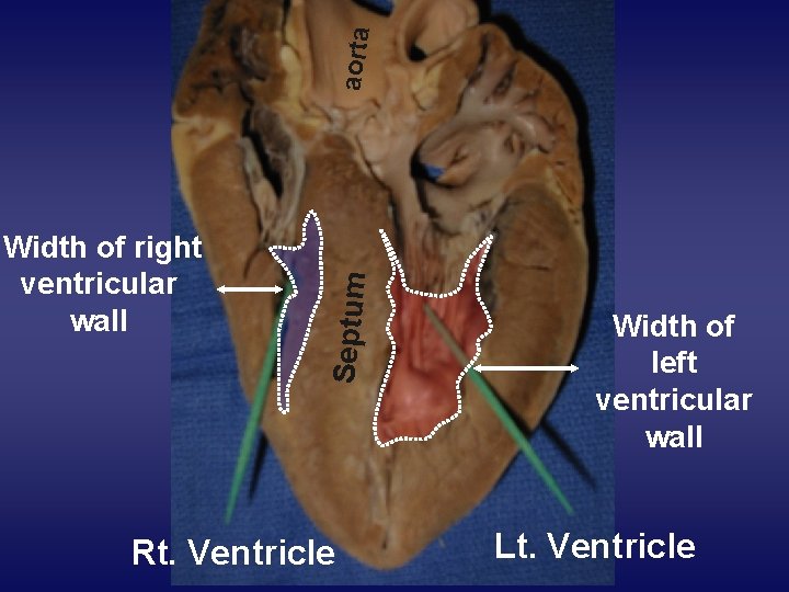 aorta Septum Width of right ventricular wall Rt. Ventricle Width of left ventricular wall
