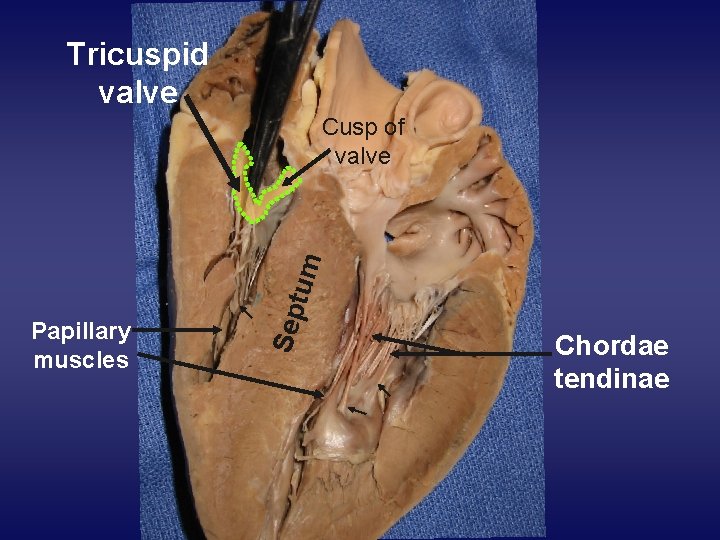 Tricuspid valve Papillary muscles Sep tum Cusp of valve Chordae tendinae 