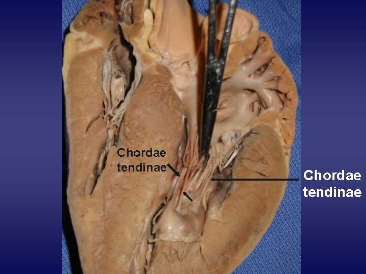 Chordae tendinae 