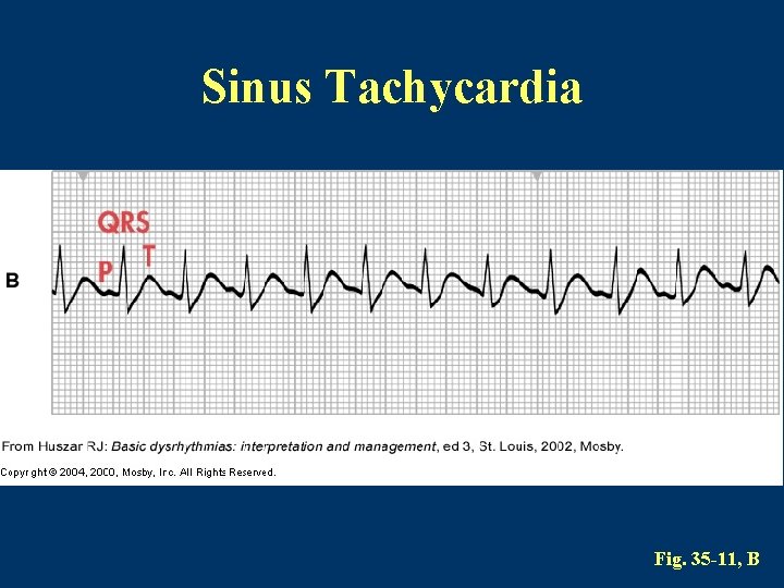 Sinus Tachycardia Fig. 35 -11, B 