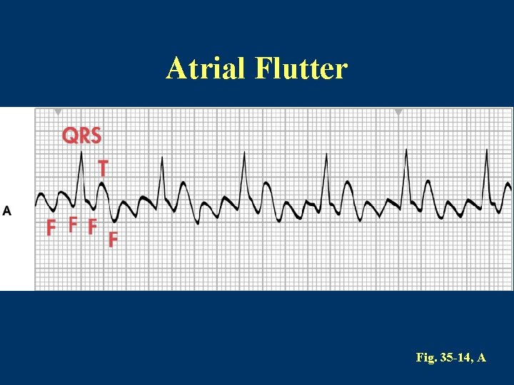 Atrial Flutter Fig. 35 -14, A 